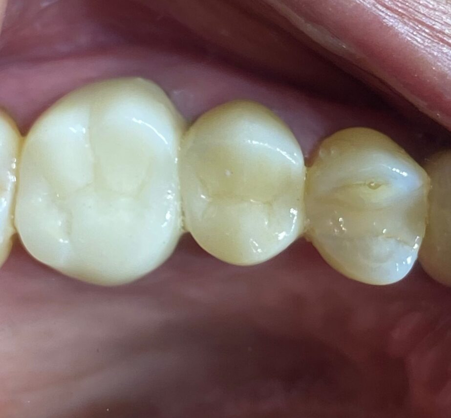 ¿Qué es una restauración dental?