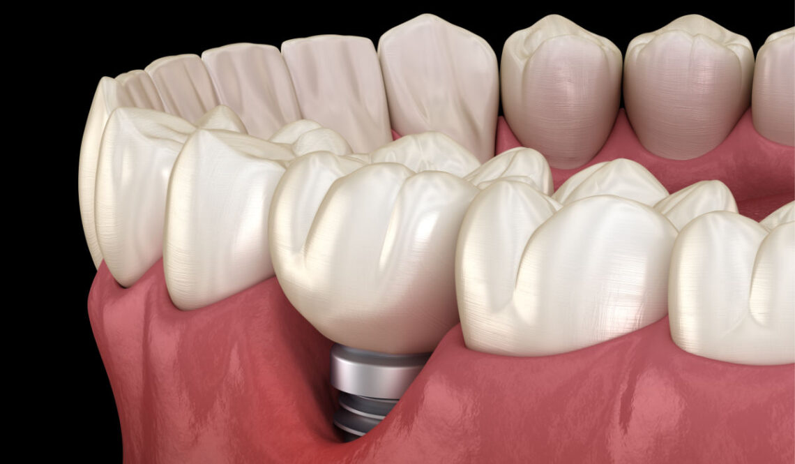 Cirugía de Implantes desde la computadora